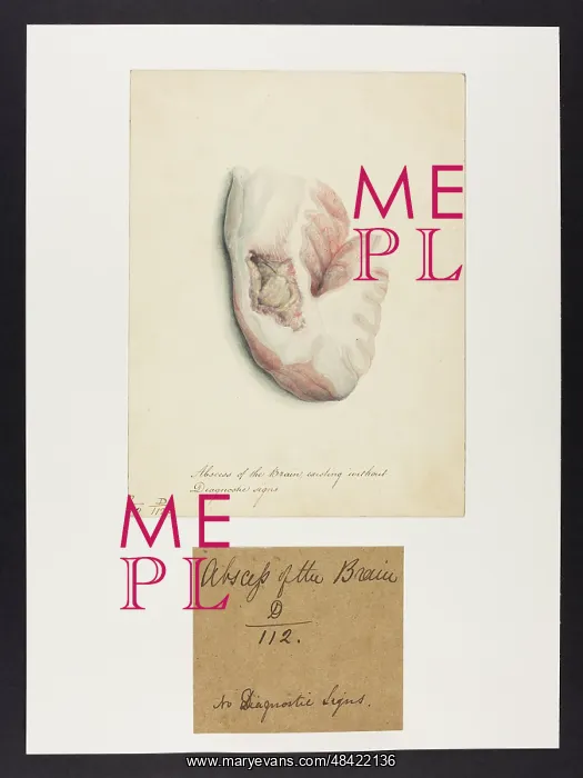 : Abscess of the Brain : Abscess of the Brain