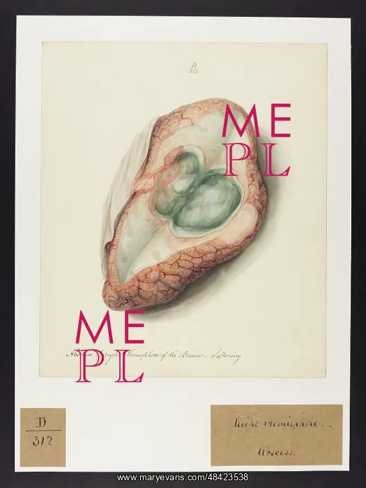 : Abscess of the Brain : Abscess of the Brain