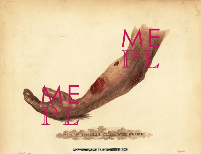 : Abscess from a gunshot wound in the forearm, 1815 : Abscess from a gunshot wound in the forearm, 1815