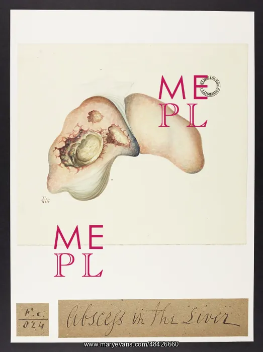 : Abscess in the Liver : Abscess in the Liver