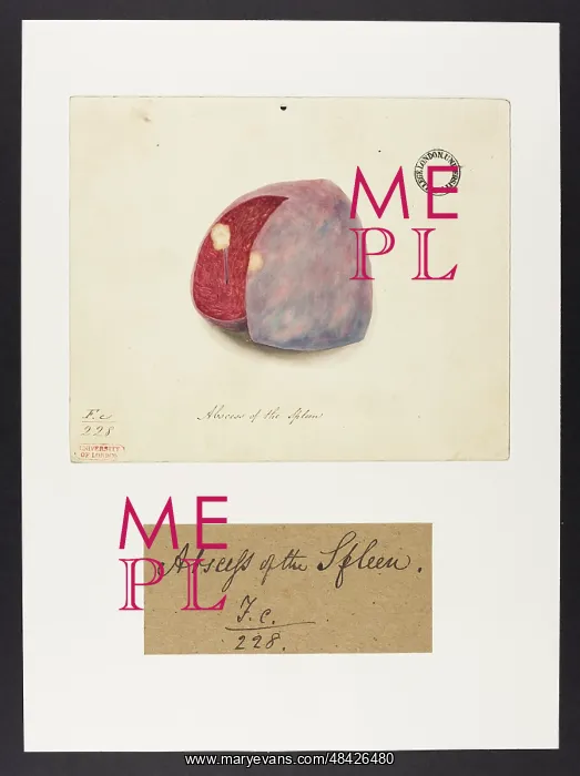 : Abscess of the Spleen : Abscess of the Spleen