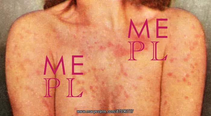  : Acute Psoriasis