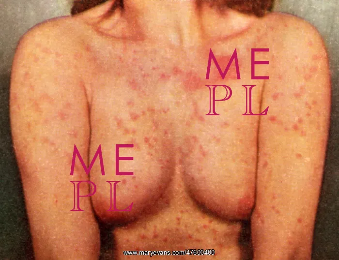  : Acute Psoriasis
