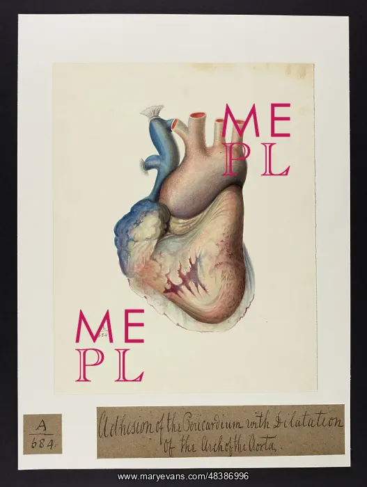 : Adhesion of the Pericardium, Dilatation of Arch of Aorta : Adhesion of the Pericardium, Dilatation of Arch of Aorta