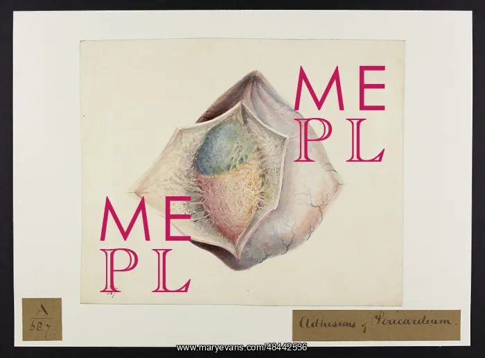 : Adhesions of Pericardium : Adhesions of Pericardium