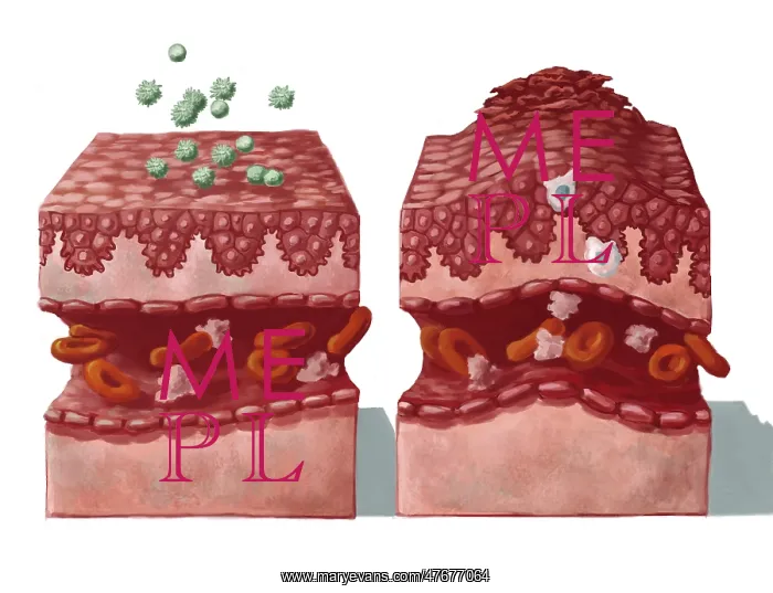: Allergy Reaction on Skin, Illustration : Allergy Reaction on Skin, Illustration