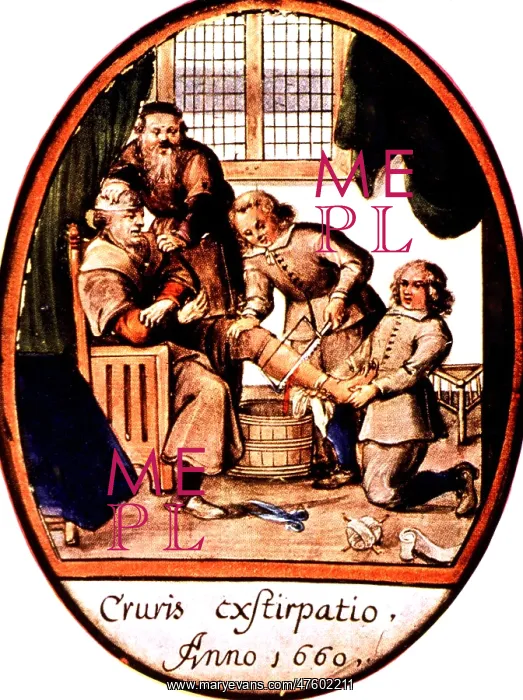 : Amputation, 1660 : Amputation, 1660