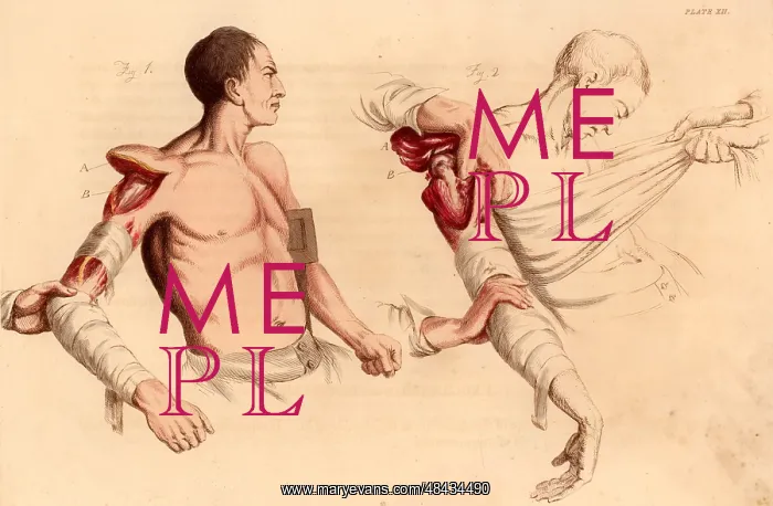 : Amputation of the arm at the shoulder. On the : Amputation of the arm at the shoulder. On the