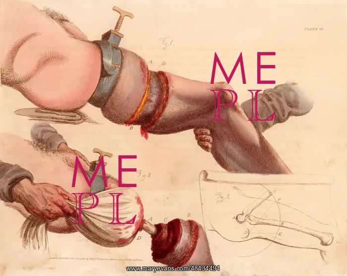 : Amputation of the leg at the thigh. The tourniquet : Amputation of the leg at the thigh. The tourniquet