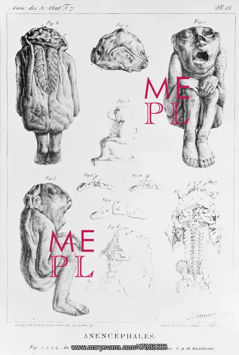 : Anencephales, deformed foetus : Anencephales, deformed foetus