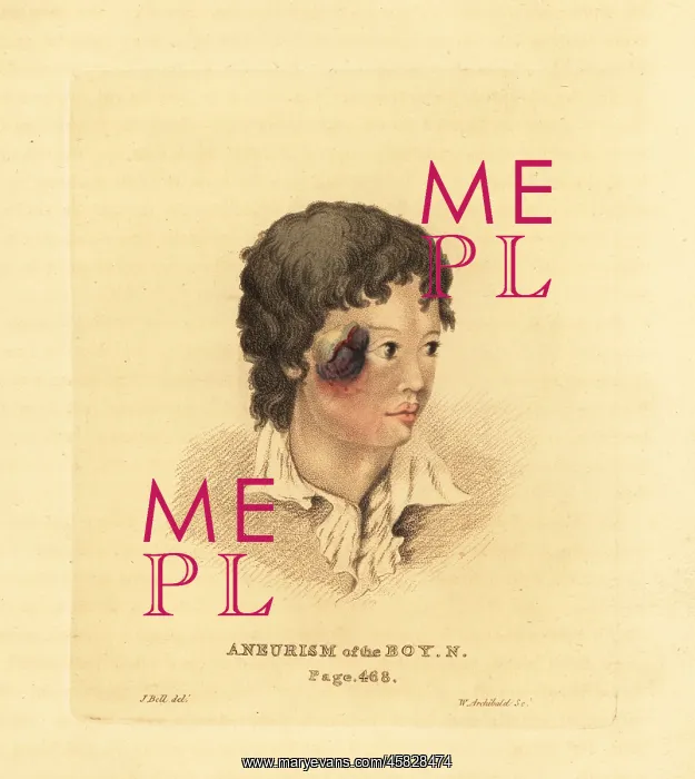 : Aneurysmal tumor on the face of a young boy N, 1815 : Aneurysmal tumor on the face of a young boy N, 1815