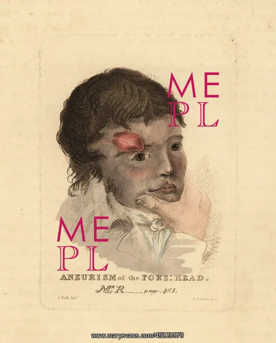: Aneurysmal tumor on the forehead of a young man, 1815 : Aneurysmal tumor on the forehead of a young man, 1815
