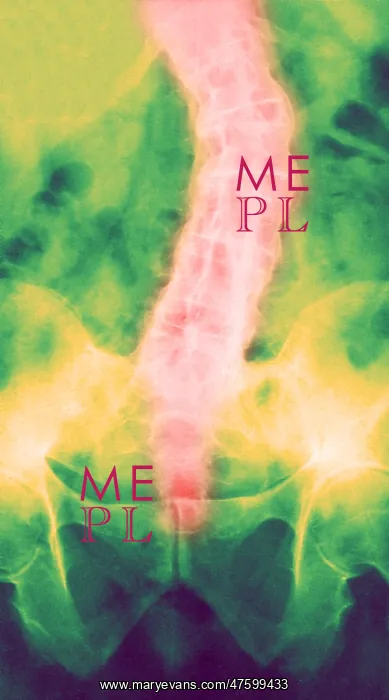 : Ankylosing Spondylitis, X-Ray : Ankylosing Spondylitis, X-Ray