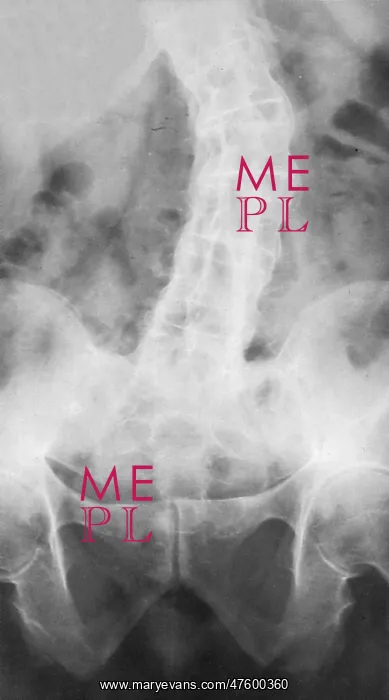 : Ankylosing Spondylitis, X-Ray : Ankylosing Spondylitis, X-Ray