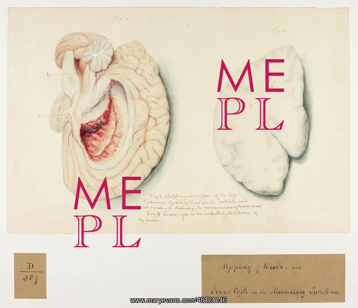 : Apoplexy of Brain and Serous Cysts : Apoplexy of Brain and Serous Cysts