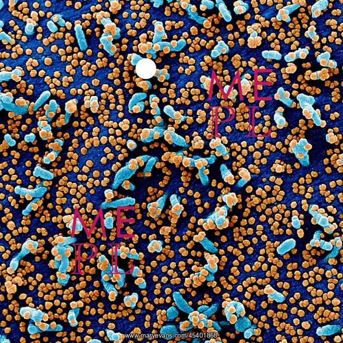 : Apoptotic cell (blue) infected with SARS-COV-2 : Apoptotic cell (blue) infected with SARS-COV-2