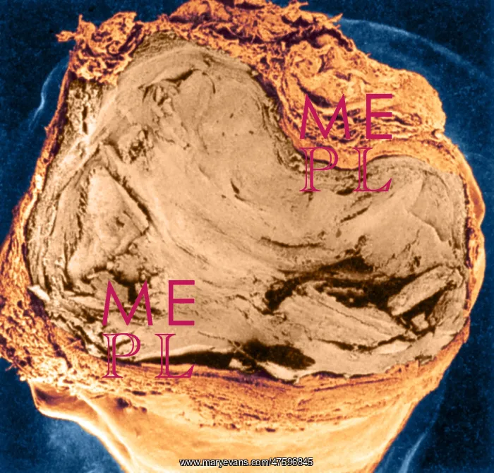 : Atherosclerosis SEM, full blockage : Atherosclerosis SEM, full blockage