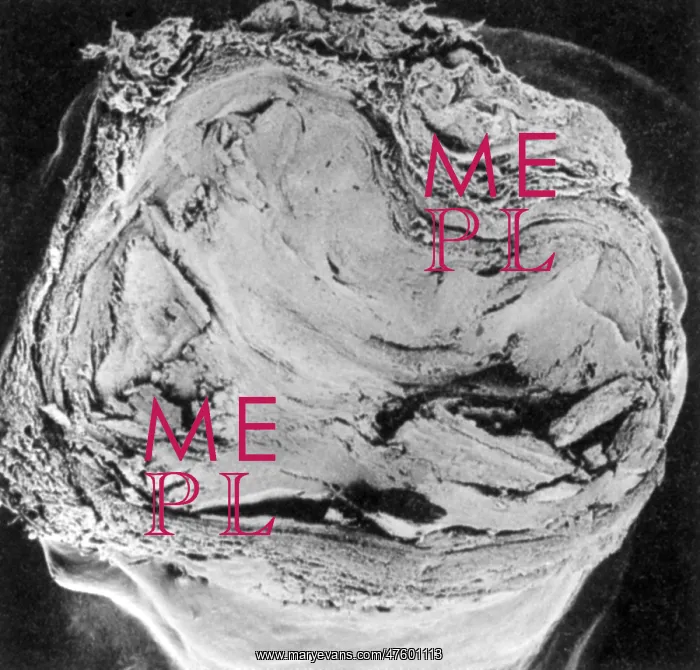  : Atherosclerosis SEM, full blockage