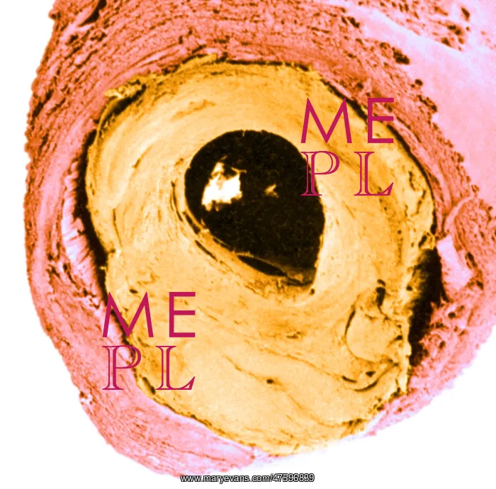 : Atherosclerosis SEM, partial blockage : Atherosclerosis SEM, partial blockage