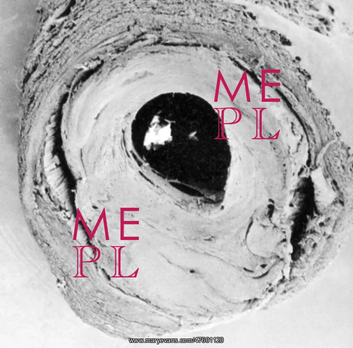 : Atherosclerosis SEM, partial blockage : Atherosclerosis SEM, partial blockage