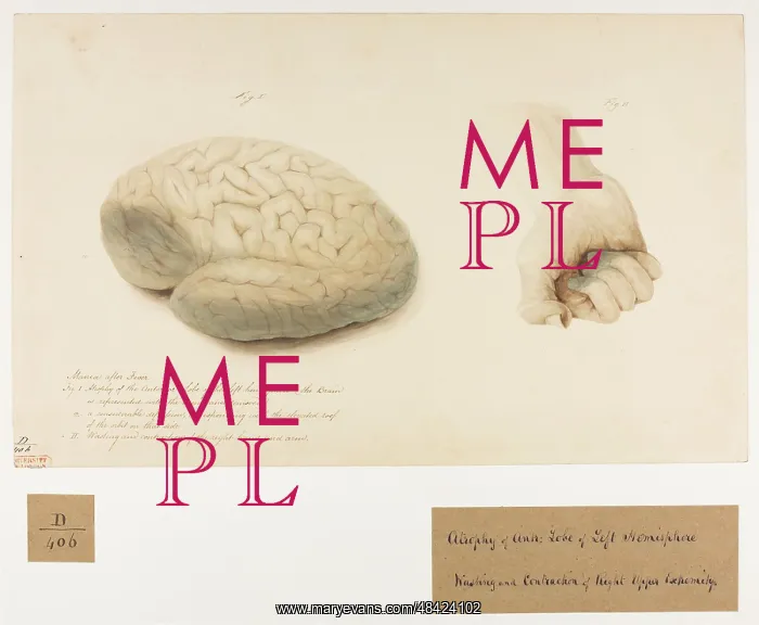 : Atrophy of Anterior Lobe of Left Hemisphere : Atrophy of Anterior Lobe of Left Hemisphere
