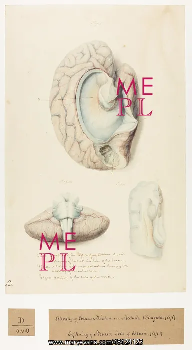  : Atrophy of corpus striatum and medulla oblongata