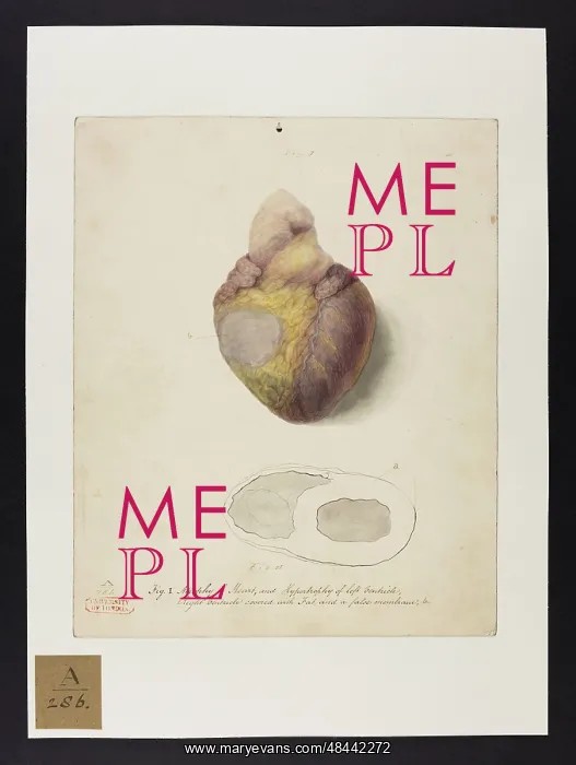 : Atrophy of Heart & Hypertrophy of Left Ventricle : Atrophy of Heart & Hypertrophy of Left Ventricle