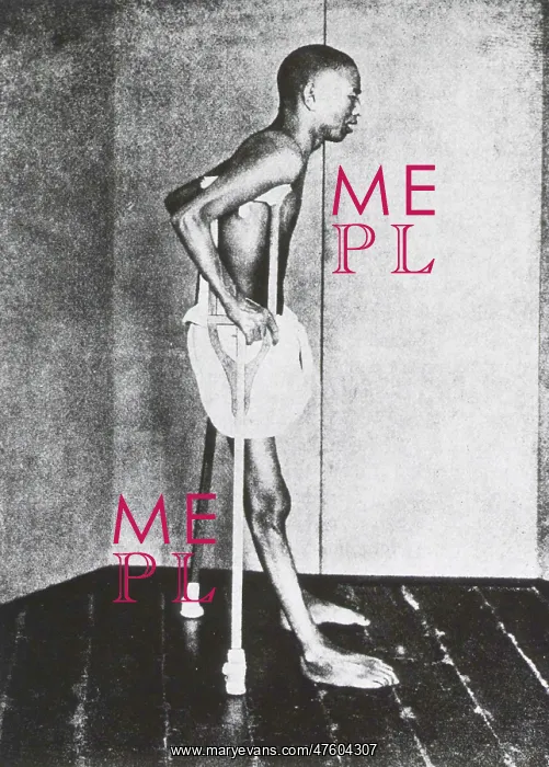: Beriberi Patient, 1914 : Beriberi Patient, 1914