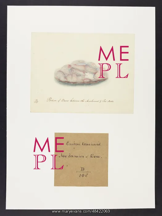 : Bone between the Arachnoid and Pia Mater : Bone between the Arachnoid and Pia Mater