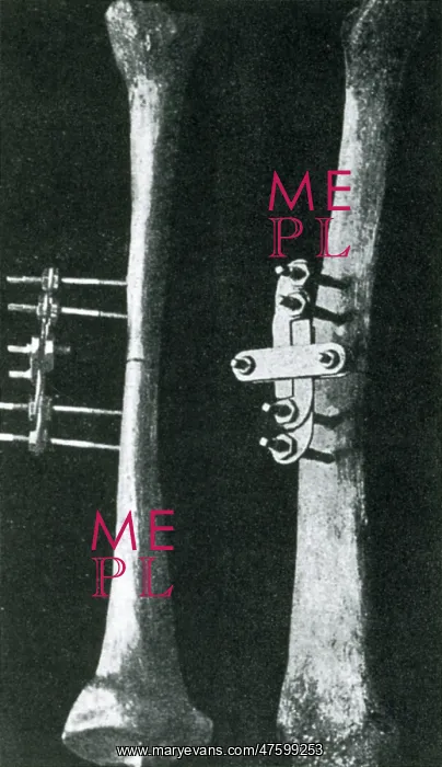: Bone Clamp : Bone Clamp