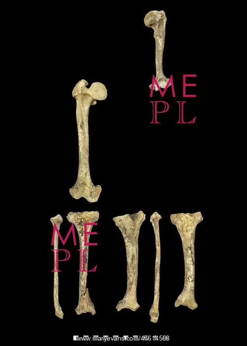 : Bones of Achondroplastic Dwarf : Bones of Achondroplastic Dwarf