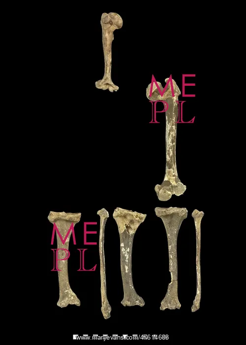 : Bones of Achondroplastic Dwarf : Bones of Achondroplastic Dwarf