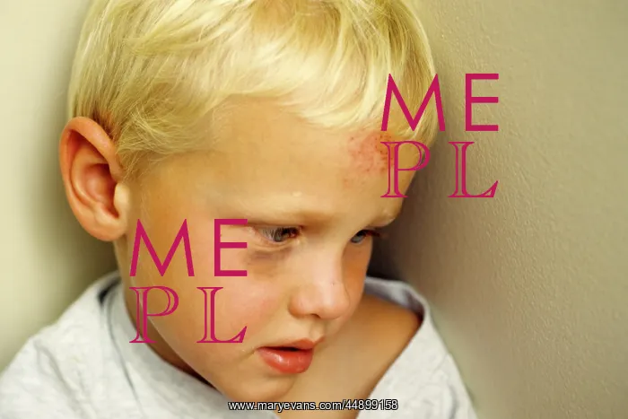  : BOY WITH BRUISED FOREHEAD