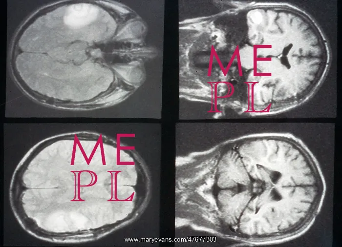 : Brain Metastases from Melanoma, MRI : Brain Metastases from Melanoma, MRI