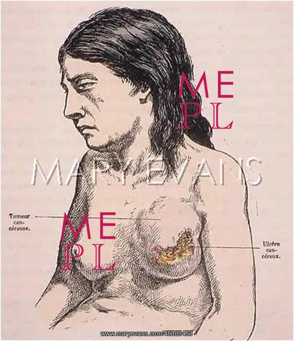 : BREAST CANCER : BREAST CANCER