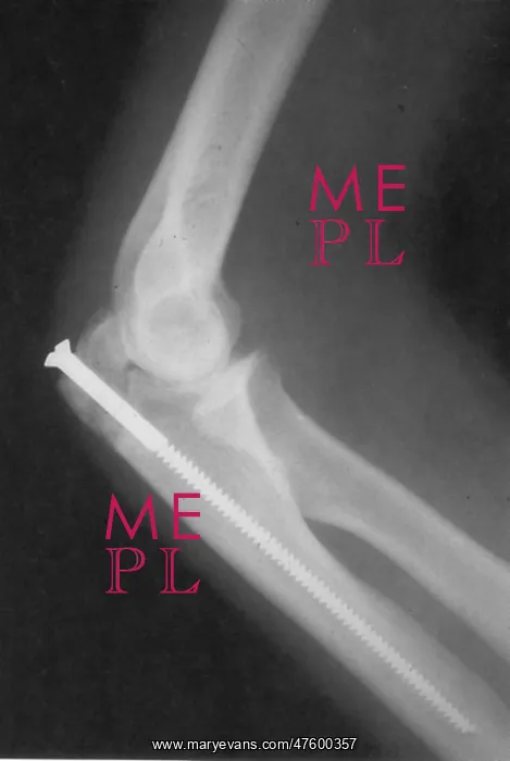 : Broken Arm with Metal Pin, X-Ray : Broken Arm with Metal Pin, X-Ray