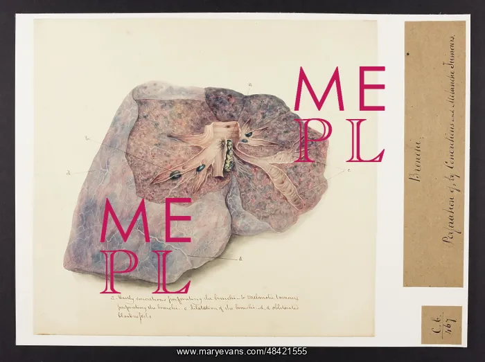 : Bronchi: perforation of, by concretions and melanotic tumours : Bronchi: perforation of, by concretions and melanotic tumours