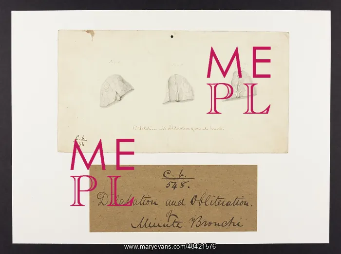 : Bronchi: Dilation and Observation : Bronchi: Dilation and Observation