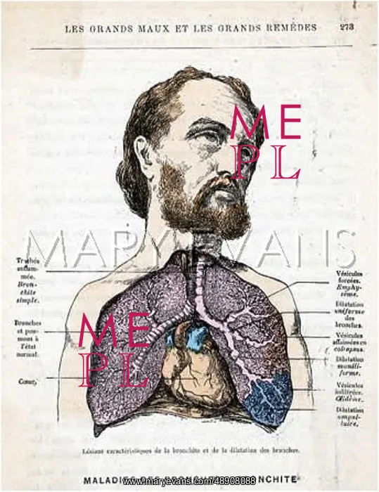 : A BRONCHITIS PATIENT : A BRONCHITIS PATIENT