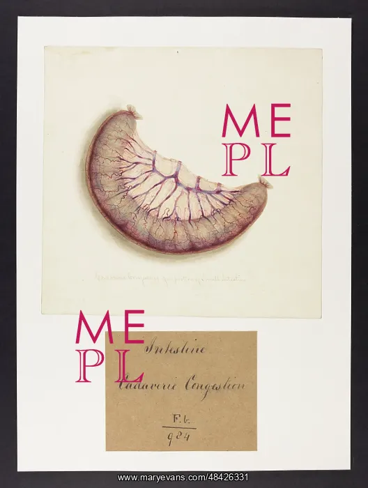 : Cadaveric Congesting of a Portion of Small Intestine : Cadaveric Congesting of a Portion of Small Intestine