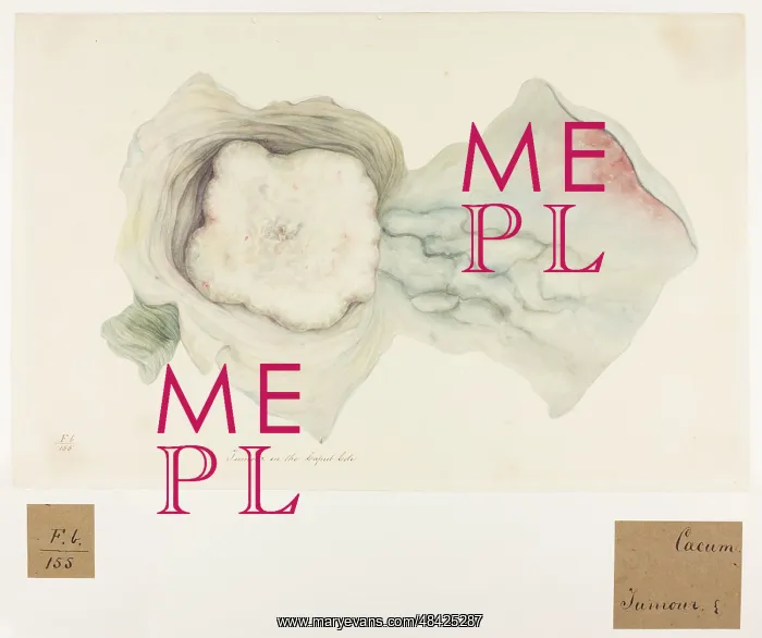 : Caecum: Tumour in the Caput Coli : Caecum: Tumour in the Caput Coli