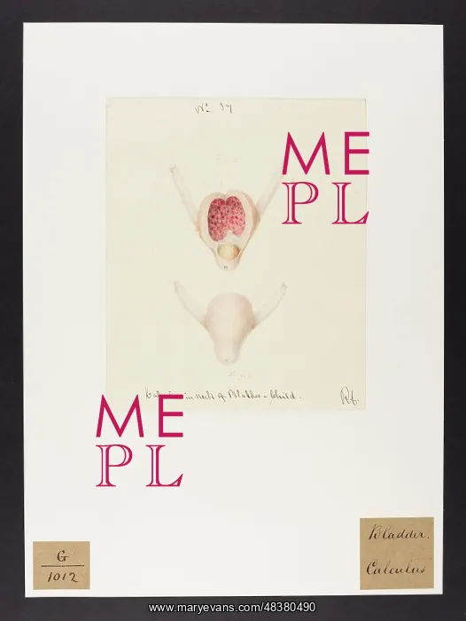 : Calculus: Neck of Bladder : Calculus: Neck of Bladder
