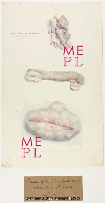 : Cancer of the Bronchial & Mesenteric Glands : Cancer of the Bronchial & Mesenteric Glands