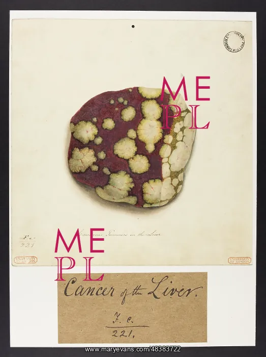 : Cancerous Tumours in the Liver : Cancerous Tumours in the Liver