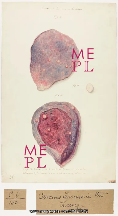 : Cancerous Tumours in the Lung : Cancerous Tumours in the Lung