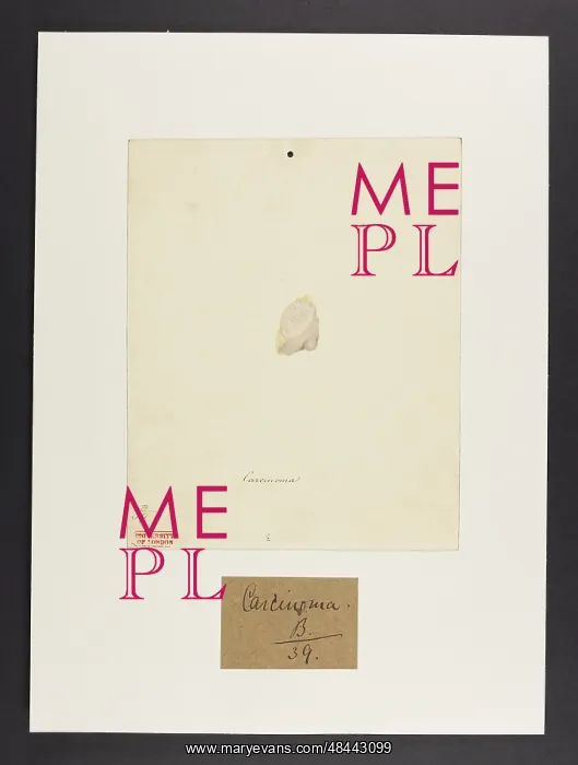 : Carcinoma. From Mons. Roux, Paris, May 4th 1828 : Carcinoma. From Mons. Roux, Paris, May 4th 1828