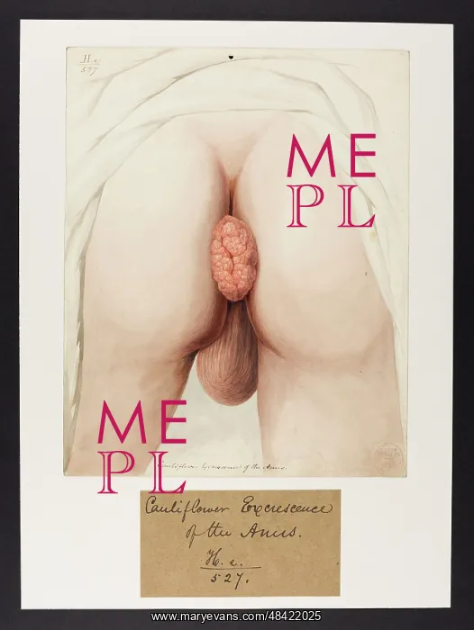 : Cauliflower Excrescence of Anus : Cauliflower Excrescence of Anus