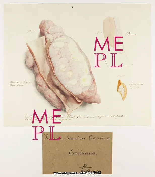 : Cerebriform Cancer of the Mesenteric Glands : Cerebriform Cancer of the Mesenteric Glands