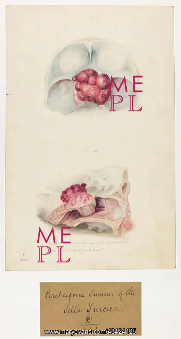 : Cerebriform Tumour : Cerebriform Tumour
