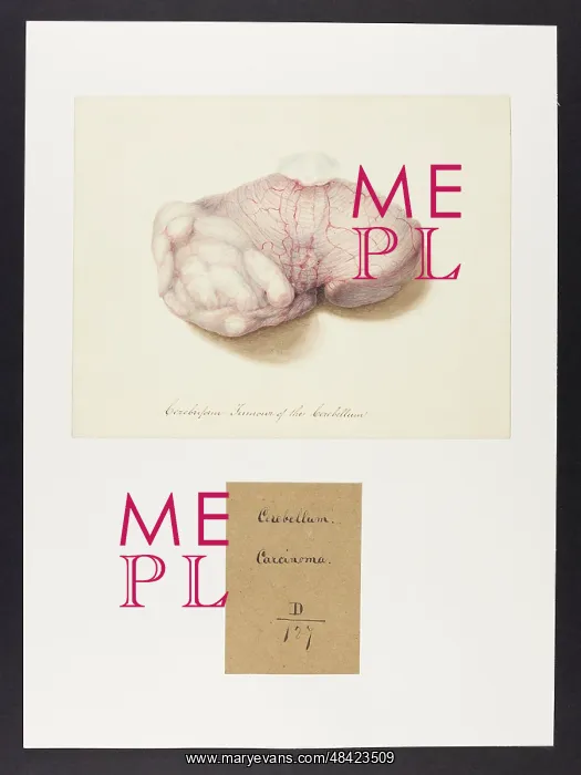 : Cerebriform Tumour of the Cerebellum : Cerebriform Tumour of the Cerebellum